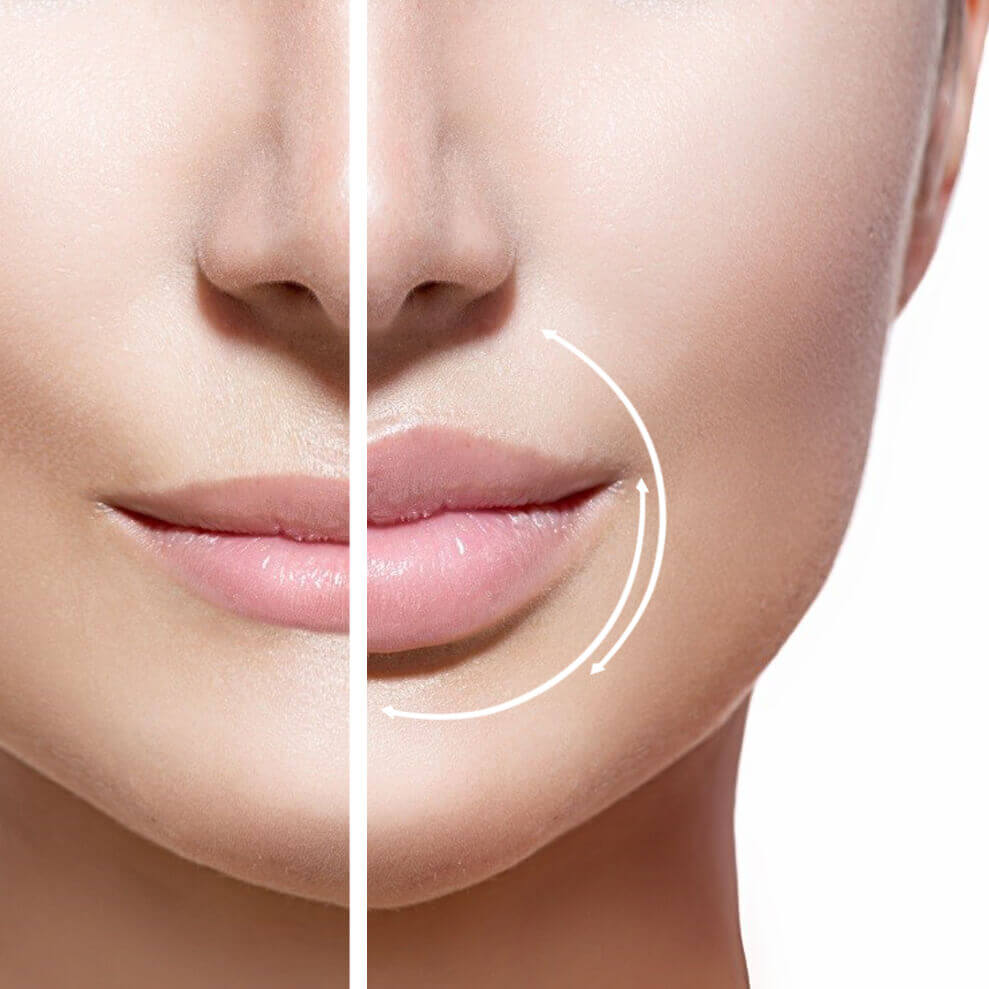 Инъекционные способы увеличения губ: Их виды и побочные действия